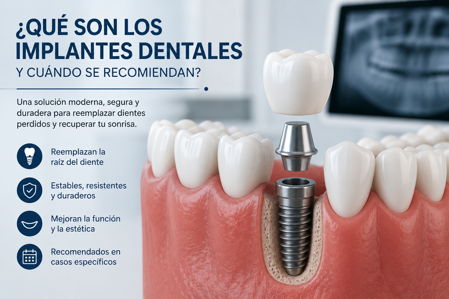 Qué son los implantes dentales y cuándo se recomiendan